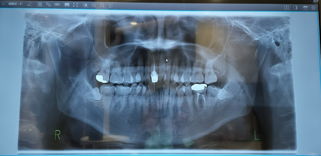 歯列矯正レントゲン